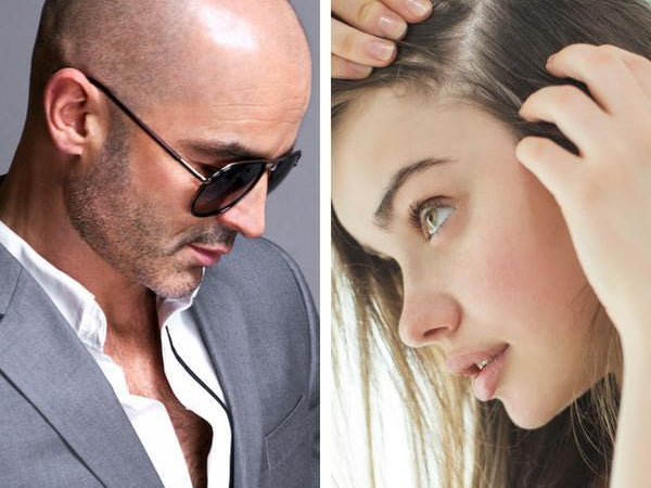 Hair Loss | Male VS. Female