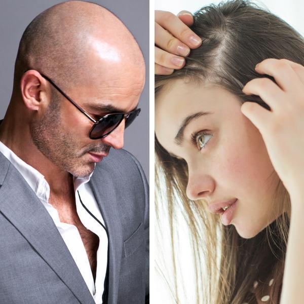 Hair Loss | Male VS. Female