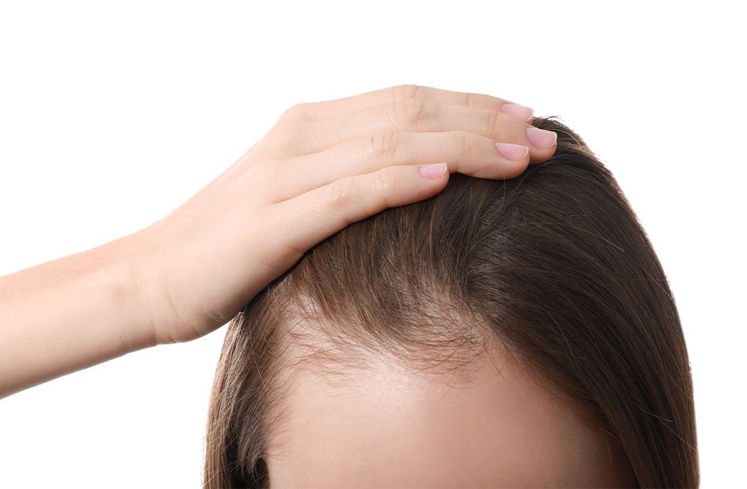 an example of traction alopecia